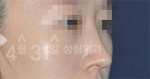 Rhinoplasty