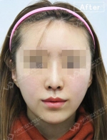 Rhinoplasty