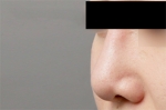 Rhinoplasty