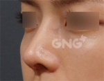 Rhinoplasty