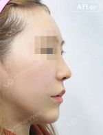 Rhinoplasty