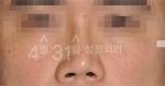 Rhinoplasty