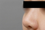 Rhinoplasty