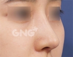 Rhinoplasty