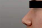 Rhinoplasty