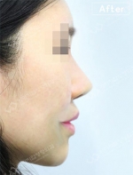 Rhinoplasty