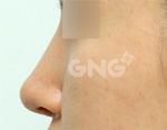 Rhinoplasty