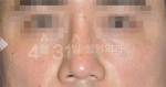 Rhinoplasty