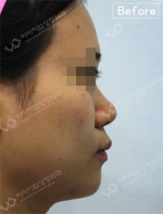 Rhinoplasty