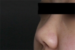 Rhinoplasty