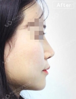 Rhinoplasty