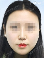 Rhinoplasty