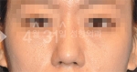 Rhinoplasty