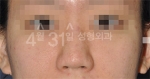 Rhinoplasty