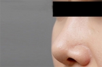 Rhinoplasty