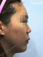 Rhinoplasty