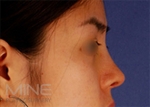 Rhinoplasty