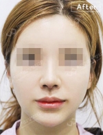 Rhinoplasty