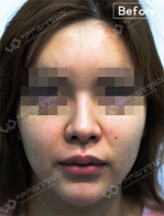 Rhinoplasty