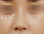 Rhinoplasty