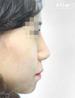 Rhinoplasty