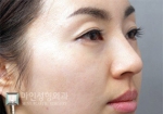 Rhinoplasty