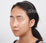 facial contouring