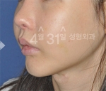 facial contouring