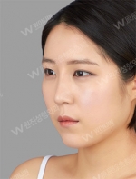 facial contouring