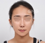 facial contouring