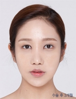 facial contouring