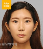 facial contouring