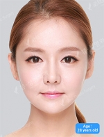 facial contouring