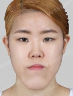 facial contouring