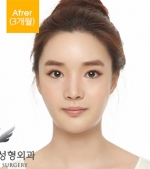 facial contouring