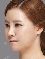 facial contouring