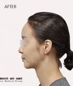 facial contouring