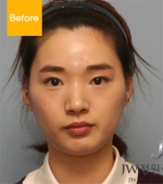 facial contouring