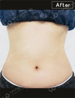 liposuction