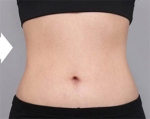 liposuction