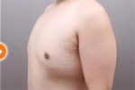 liposuction