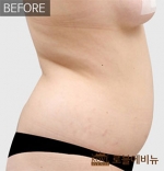 liposuction