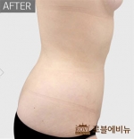 liposuction