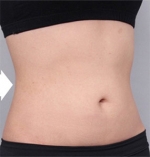 liposuction