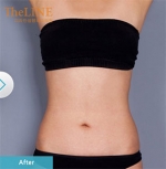 liposuction