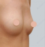 breast