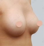 breast