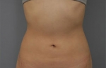 liposuction