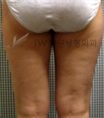 liposuction