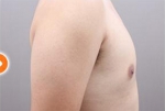 liposuction